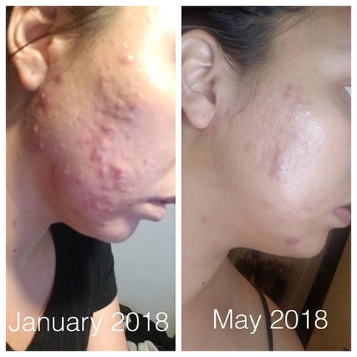 Butter Me Up Super Acne Fighter / Organic Acne Treatment