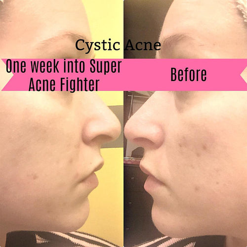 Butter Me Up Super Acne Fighter / Organic Acne Treatment